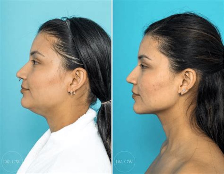 A Deeper Look Into Ptosis
