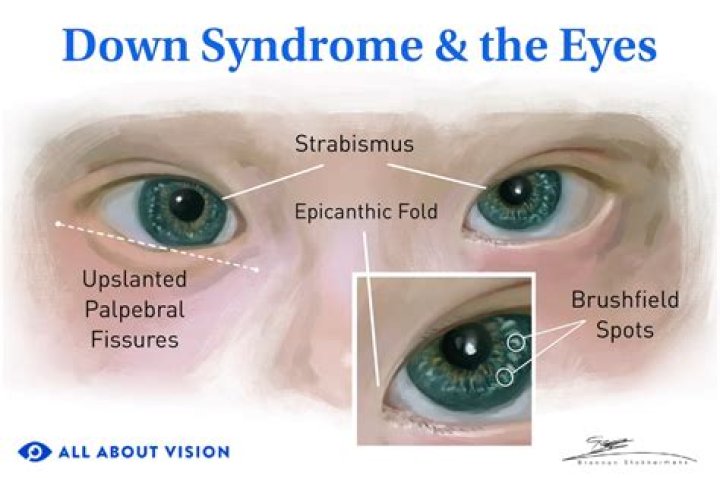 A Shining Light With Down Syndrome