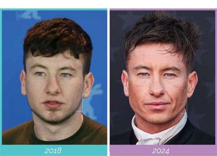 Barry Keoghan's Plastic Surgery Journey