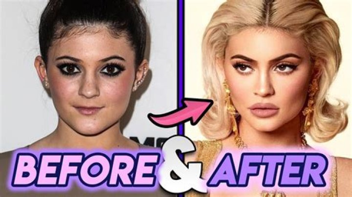 Before And After Kylie Jenner's Transformation