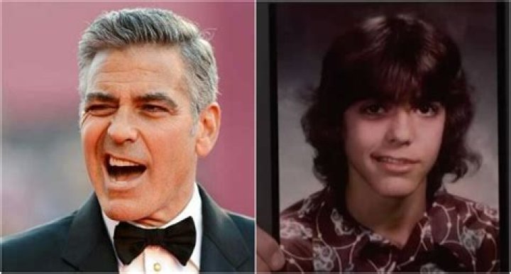 Bell's Palsy: Understanding George Clooney's Condition