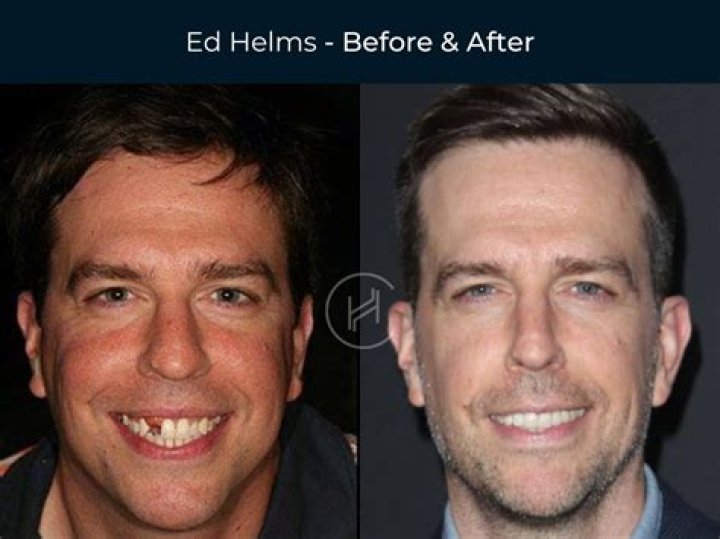 Ben Affleck's Dentures: A Hollywood Tale Of Smiles And Struggles