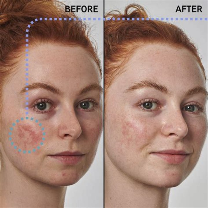 Can Hyaluronic Acid And Azelaic Acid Be Used Together?