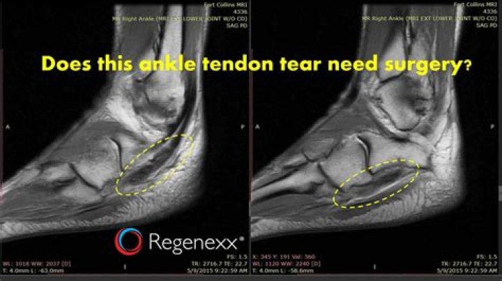 Can You Self-Heal A Torn Tendon?