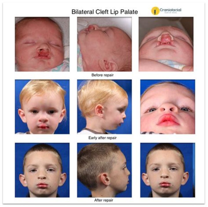 Cleft Palate Before And After The Spotlight