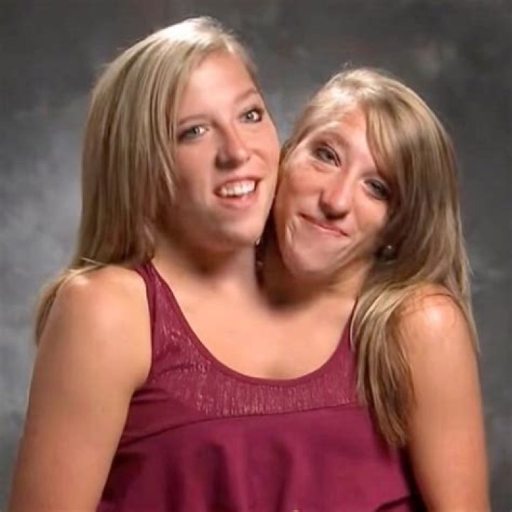 Conjoined Twins Abby And Brittany Hensel: An Inspiring Story Of 2021
