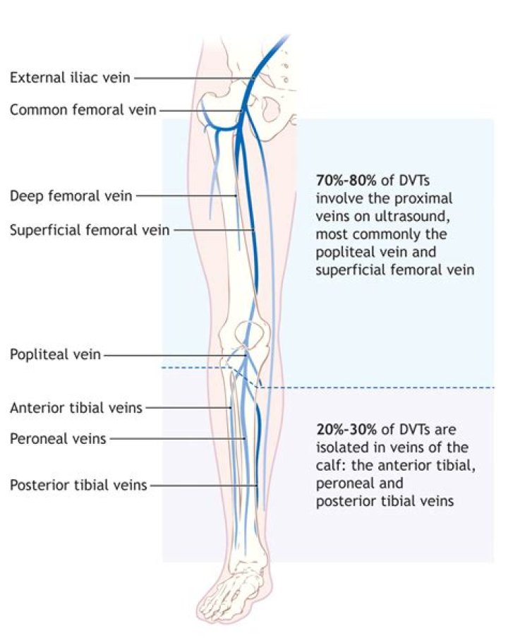 Deep Vein Thrombosis Of The Right Calf: ICD-10 Classification