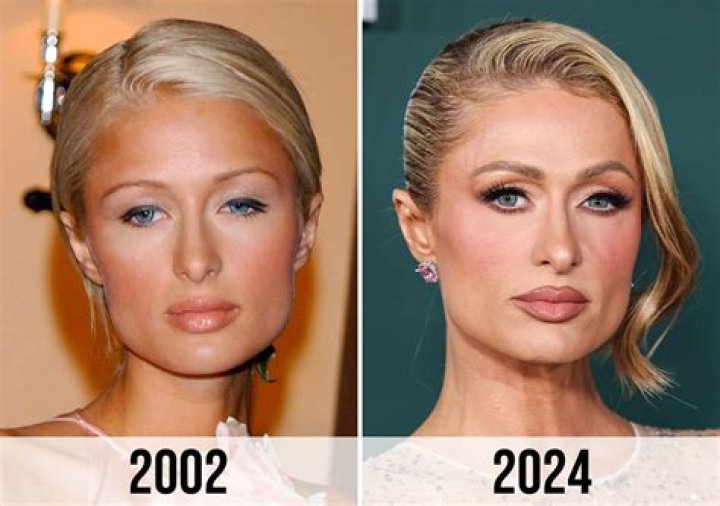 Did Paris Hilton's Transformation Involve Cosmetic Surgery?