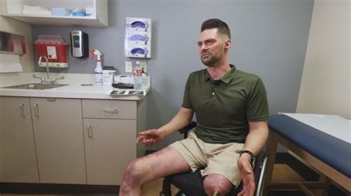 Did Robert Redford Experience A Leg Amputation?