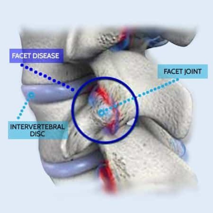 Discover Facet Hypertrophy: Causes, Symptoms, And Treatment Options