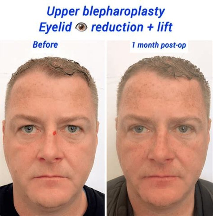 Discover The Secrets Of Celebrity Hooded Eye Surgery