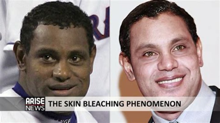 Discover The Shocking Truth Behind Celebrity Skin Bleaching