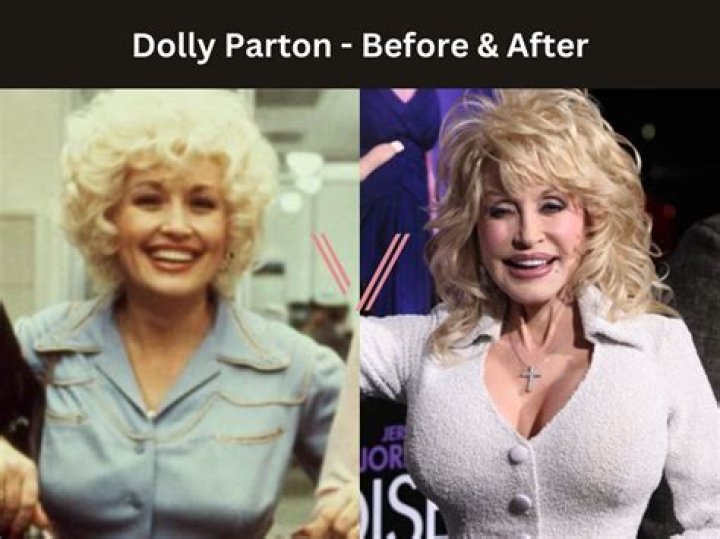 Discover The Truth Behind Dolly Parton's Iconic Bust: Breast Implants Unveiled