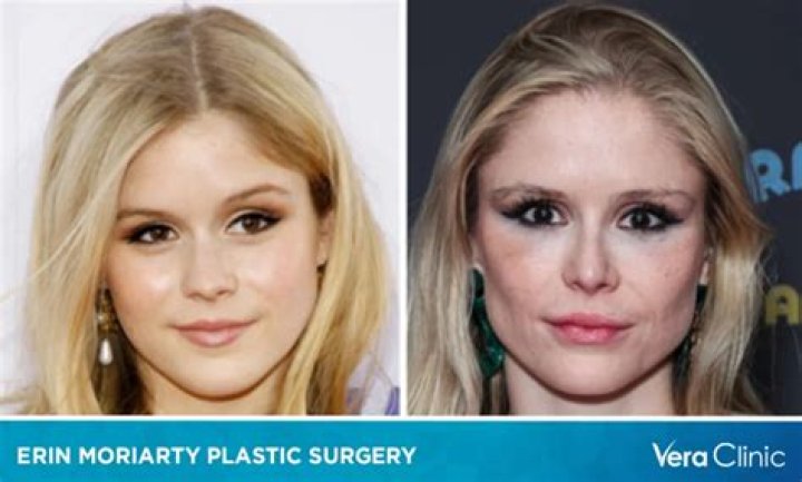 Erin Moriarty's Plastic Surgery Transformations
