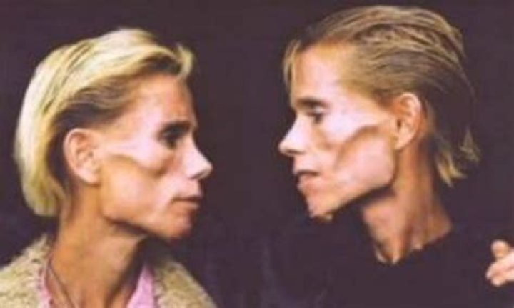 Famous anorexic identical twins die in house fire following prophecy they would die together ·