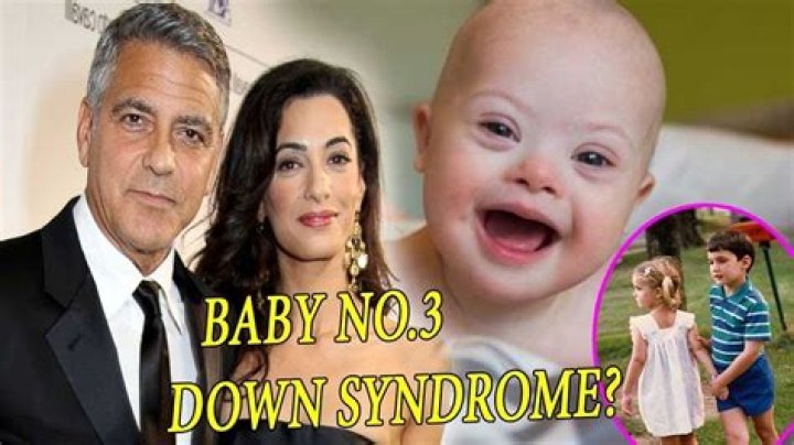George Clooney's Son: Living With Down Syndrome