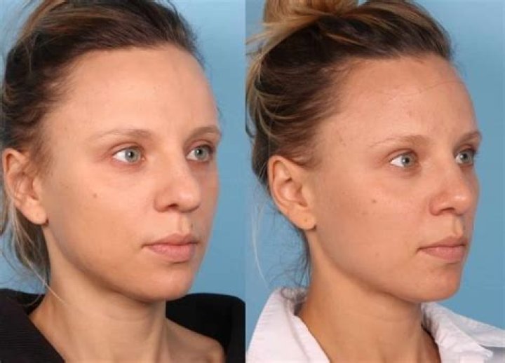 Gypsy Rose's Rhinoplasty: Before And After Transformation