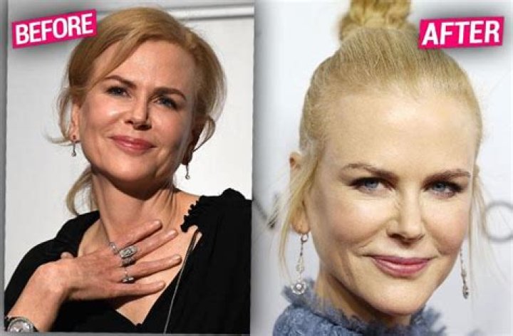 Has Nicole Kidman Undergone A Facelift? Examining The Evidence