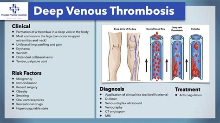 ICD-10 Codes For Deep Vein Thrombosis In The Lower Extremity