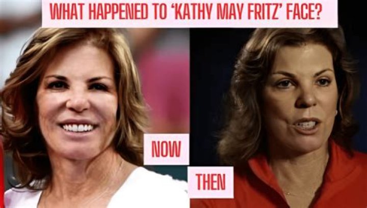 Is Kathy May's Face Surgery Secret Out?