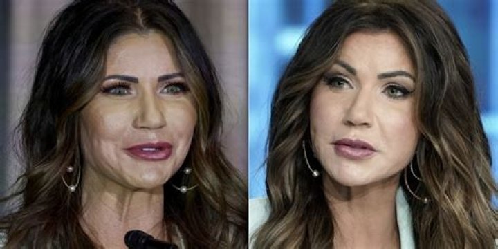Kristi Noem's Plastic Surgery: Before And After Transformation