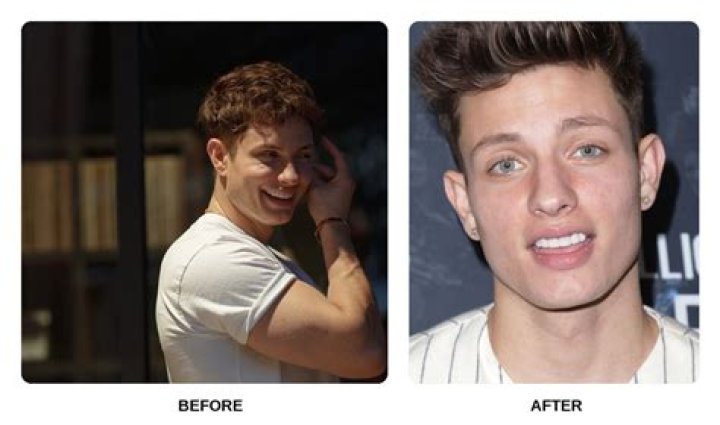 Learn The Truth About Matt Rife's Dental Health