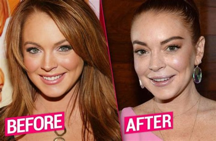 Lindsay Lohan's Plastic Surgery Journey: Before And After