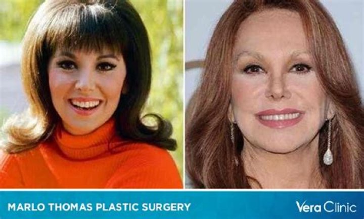 Marlo Thomas's Transformation: Before And After Plastic Surgery
