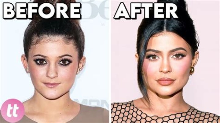 Paris Hilton's Transformation: Before And After Plastic Surgery