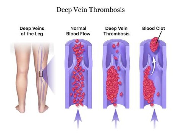 Ruling Out Deep Vein Thrombosis