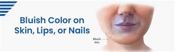 Skin discoloration - bluish ·