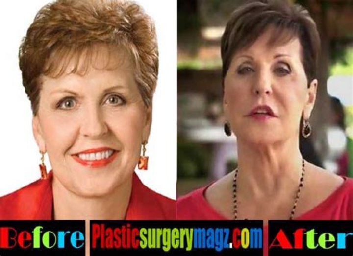 Surprising Joyce Meyer Plastic Surgery Transformation