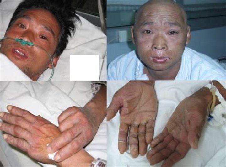 The Devastating Aftermath: Hisashi Ouchi's Photos Reveal The True Horrors Of Radiation Exposure
