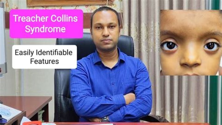 The Enigmatic Actor: Uncovering Treacher Collins Syndrome