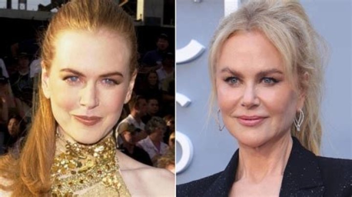 The Ultimate Guide To Nicole Kidman's Plastic Surgery: Insights And Analysis