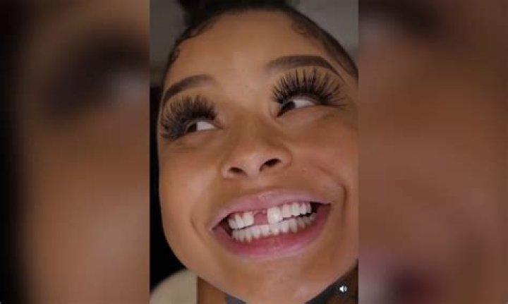 Uncover The Truth Behind Chrisean's Missing Tooth