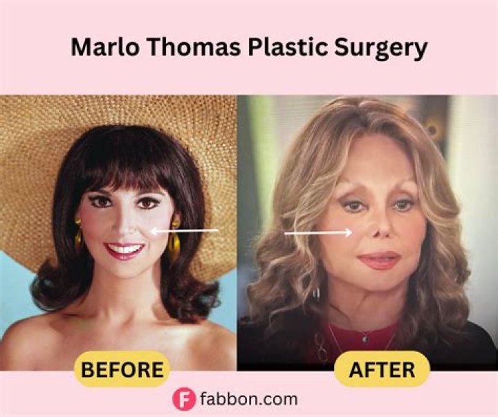 Uncovering The Truth: Has Marlo Thomas Undergone Plastic Surgery?