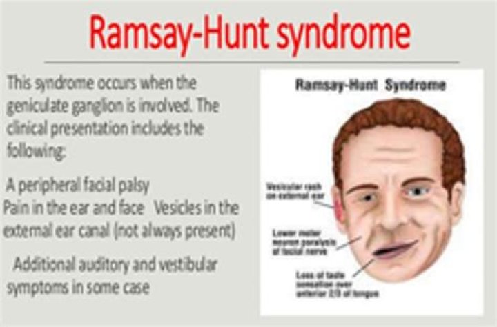Understanding Ramsay Hunt Syndrome: Causes, Symptoms And Treatment