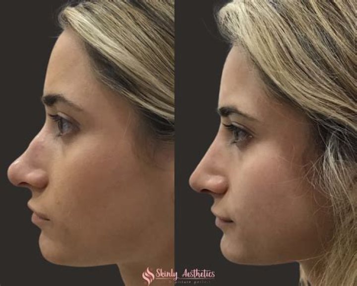 Unlocking A New You: Dramatic Rhinoplasty Transformations