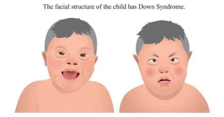 Unraveling The Wonders Of Down Syndrome