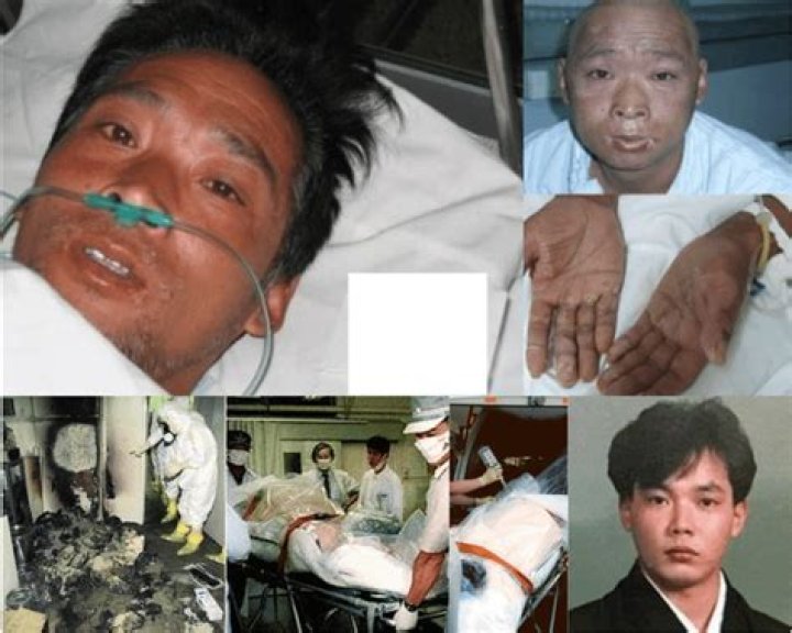 Unseen Photos Of Hisashi Ouchi: A Tragic Tale Of Radiation Exposure