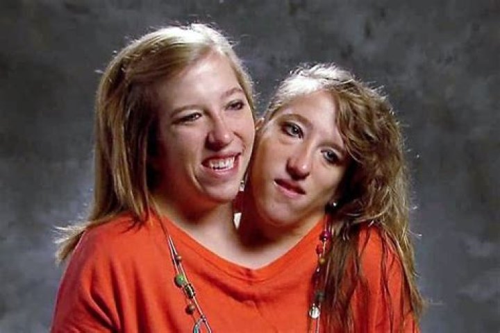 Untimely Demise Of Conjoined Twins Abby And Brittany Hensel