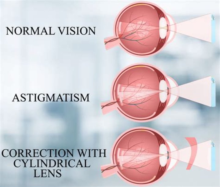 Unveil The Secrets Of Astigmatism Lights: A Journey To Clarity