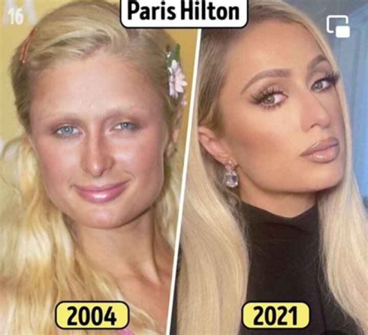 Unveiling The Secrets Of Paris Hilton's Plastic Surgery Journey: Discoveries And Insights