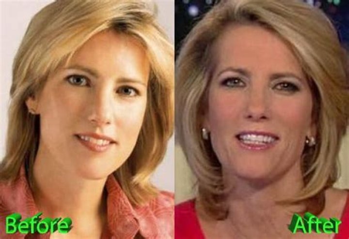Unveiling The Truth: Exploring Laura Ingraham's Plastic Surgery Journey